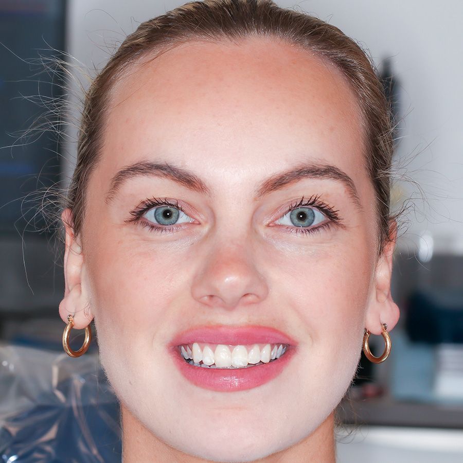Composite Bonding - Niamh O'Sullivan - Before
